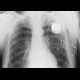 Bullous emphysema: X-ray - Plain radiograph
